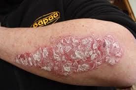 What is Psoriasis? Full Information on Symptoms, Causes & Remedies