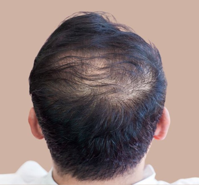 Exosome Hair Therapy Ahmedabad