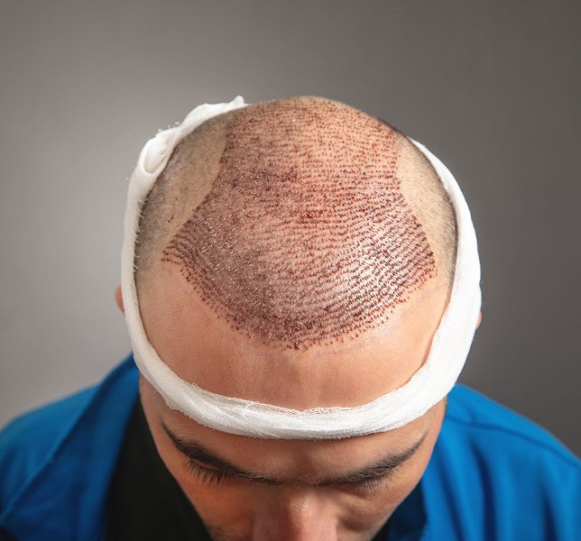 Hair Transplant Ahmedabad