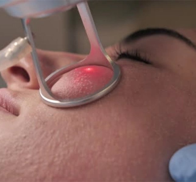 CO2 Laser Treatment Ahmedabad
