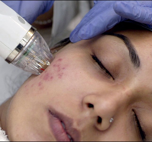 MNRF Treatment Ahmedabad