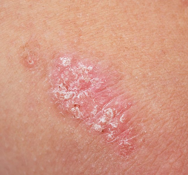 Psoriasis Treatment Ahmedabad