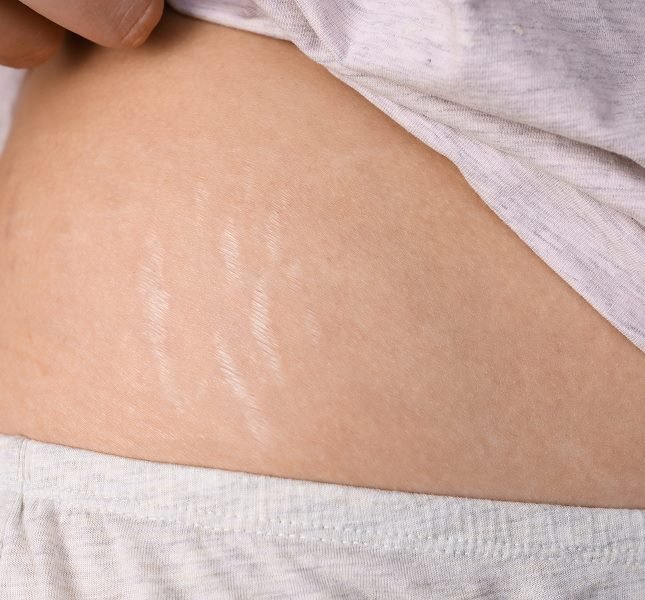 Stretch Mark Removal Ahmedabad
