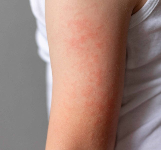 Urticaria Treatment Ahmedabad