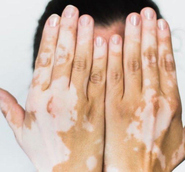 Vitiligo Treatment Ahmedabad