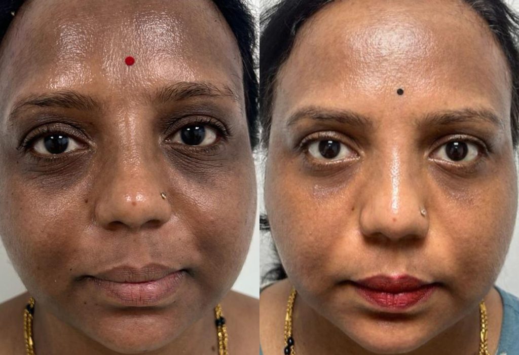 Laser Toning