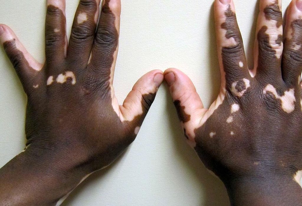 Vitiligo