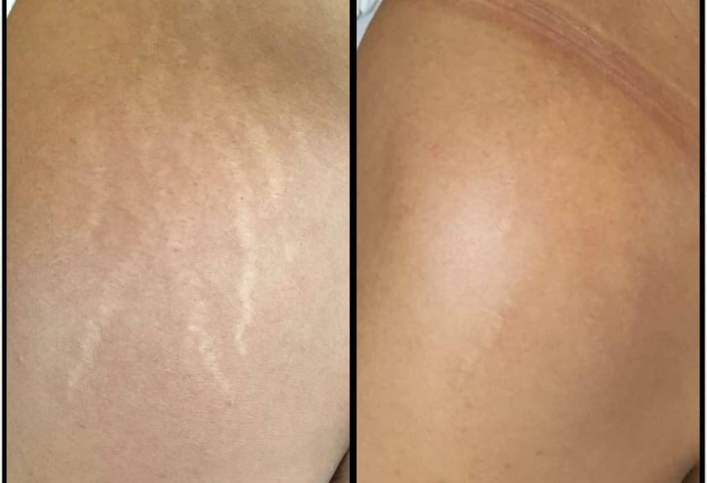 Stretch Mark Removal