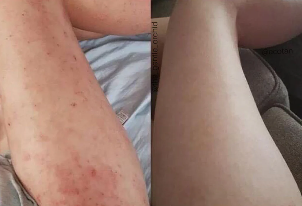 Eczema