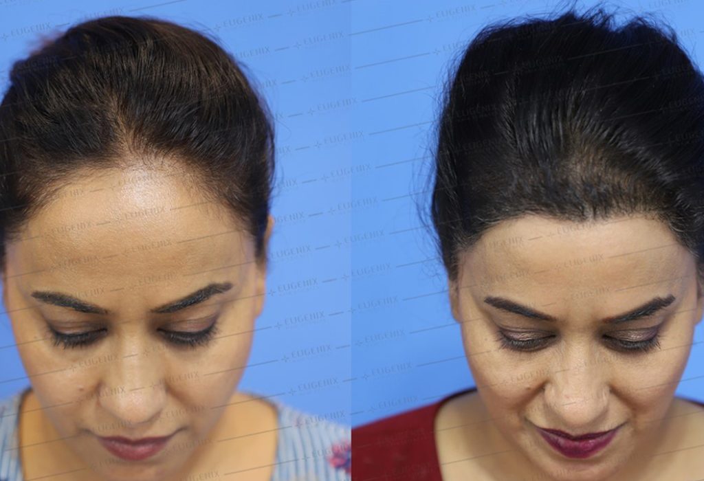 Hair-Transplant-In-Females