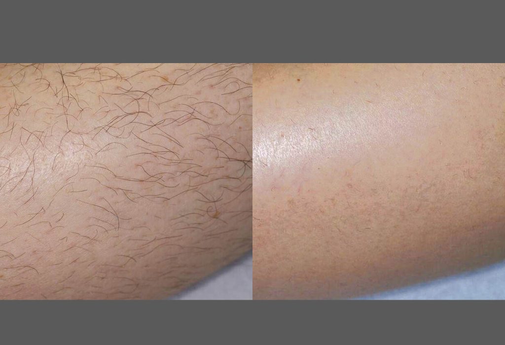 Laser Hair Removal