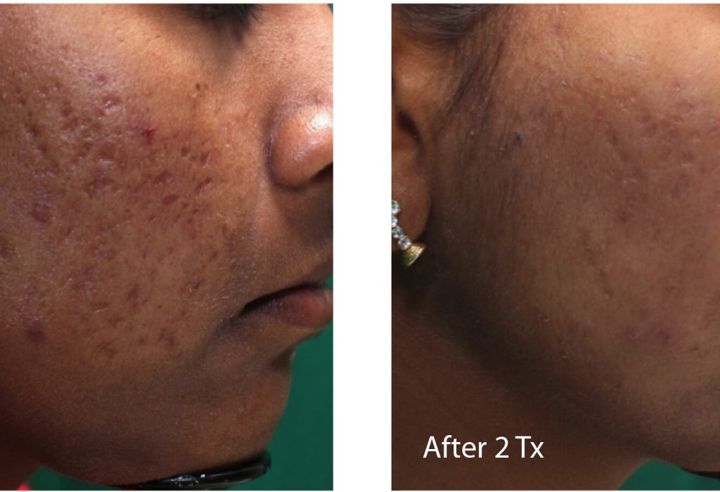 Infini_Shah_fullface1_acne_beforeandafter-01-01