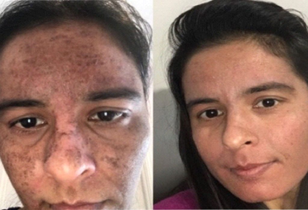 NON-Chemical-Peel