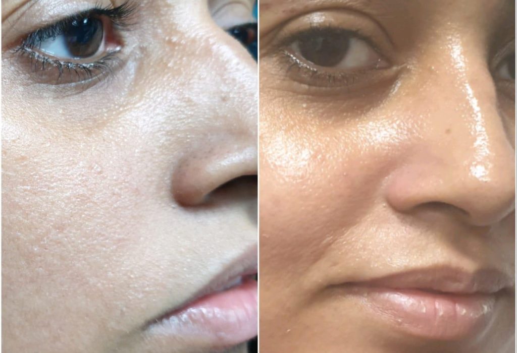 Laser Toning