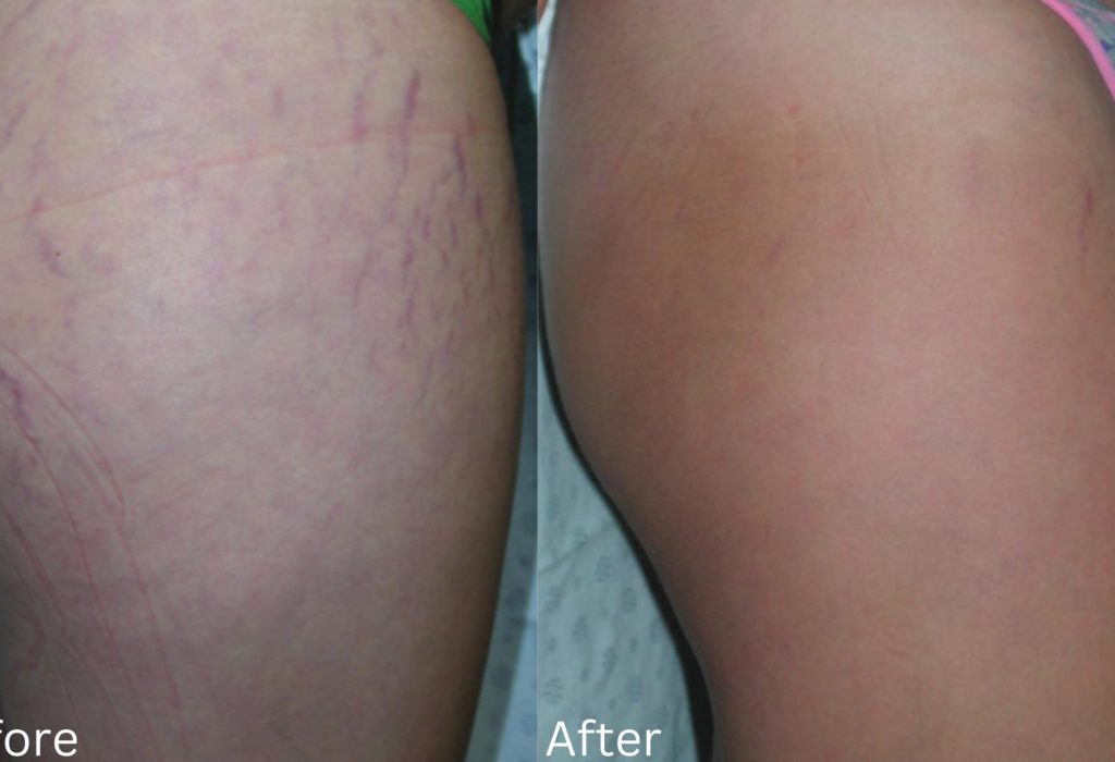 Stretch Mark Removal