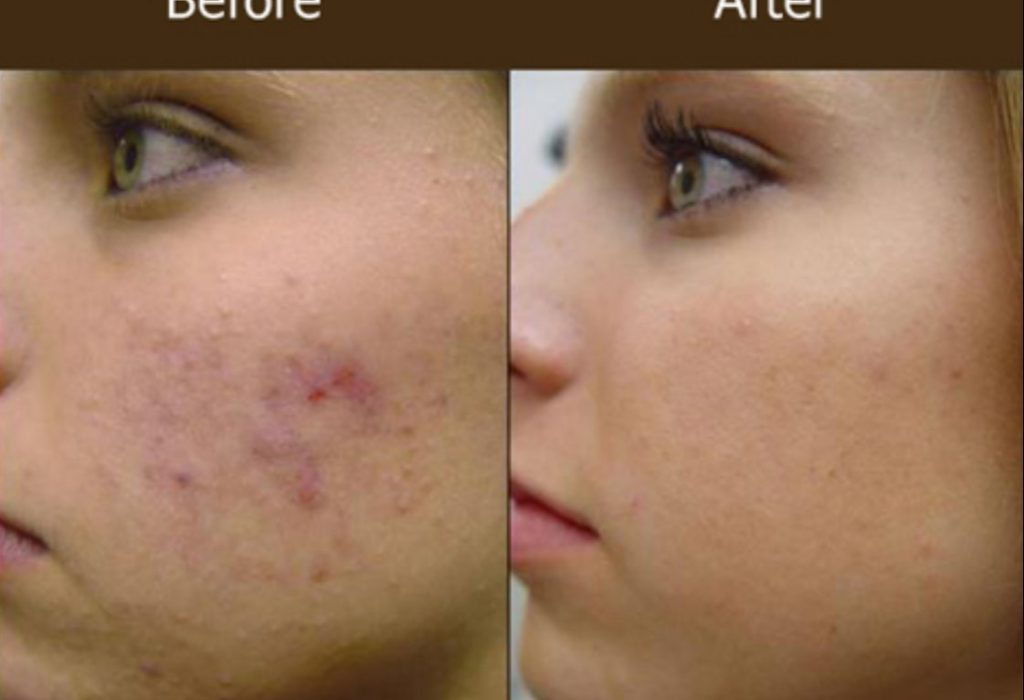 acne-scars-removal-treatment-service