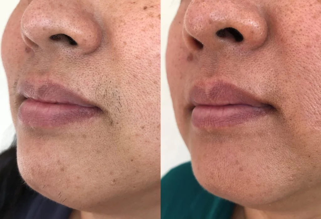 before-and-after-Laser-hair-removal-on-face