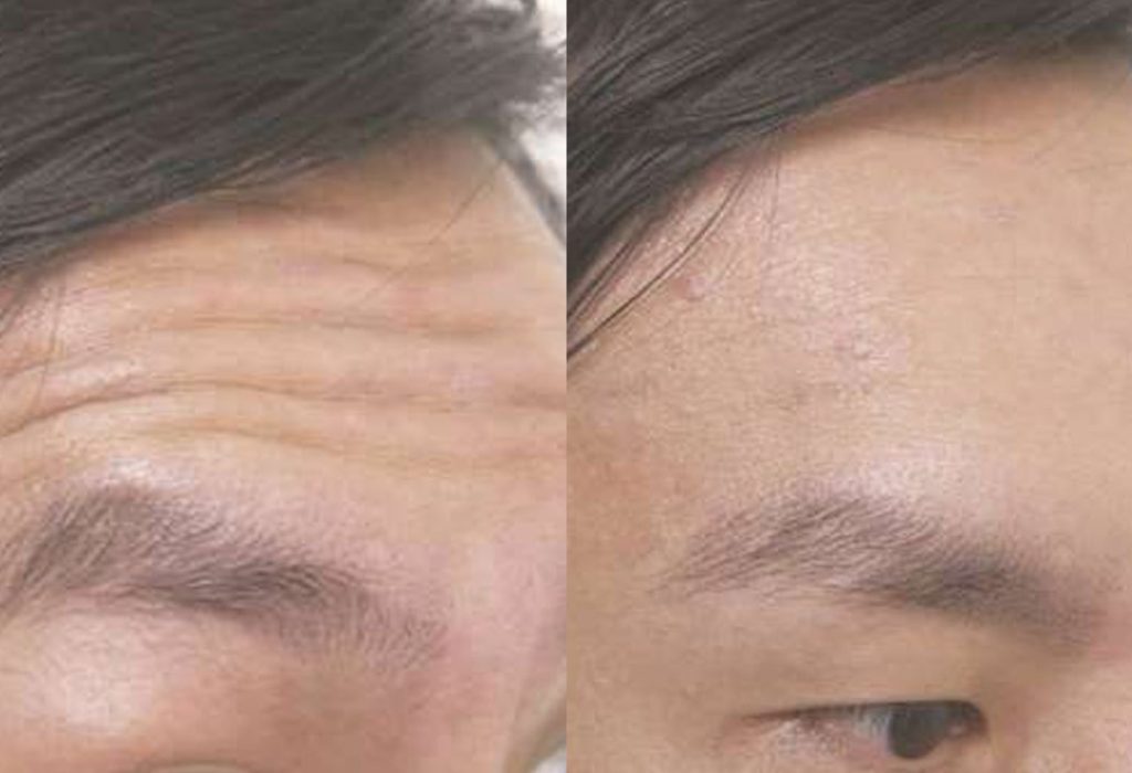 Botox/Anti-Wrinkle