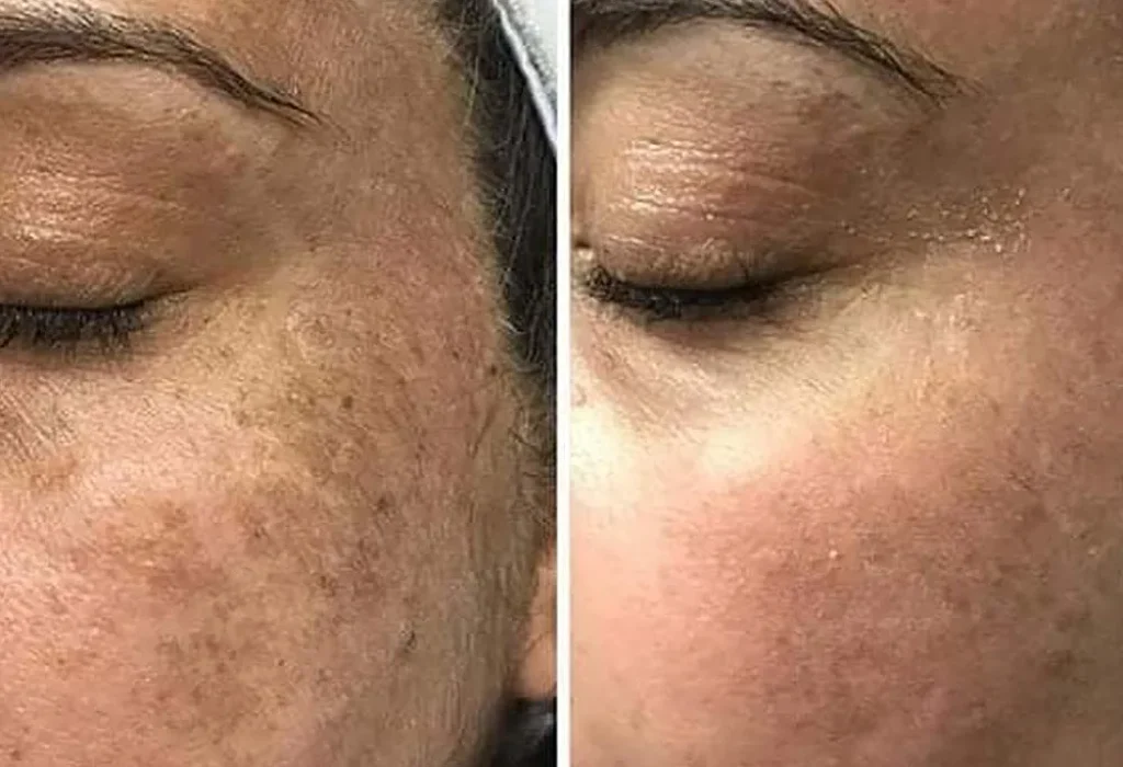 Chemical Peel/Laser Peel