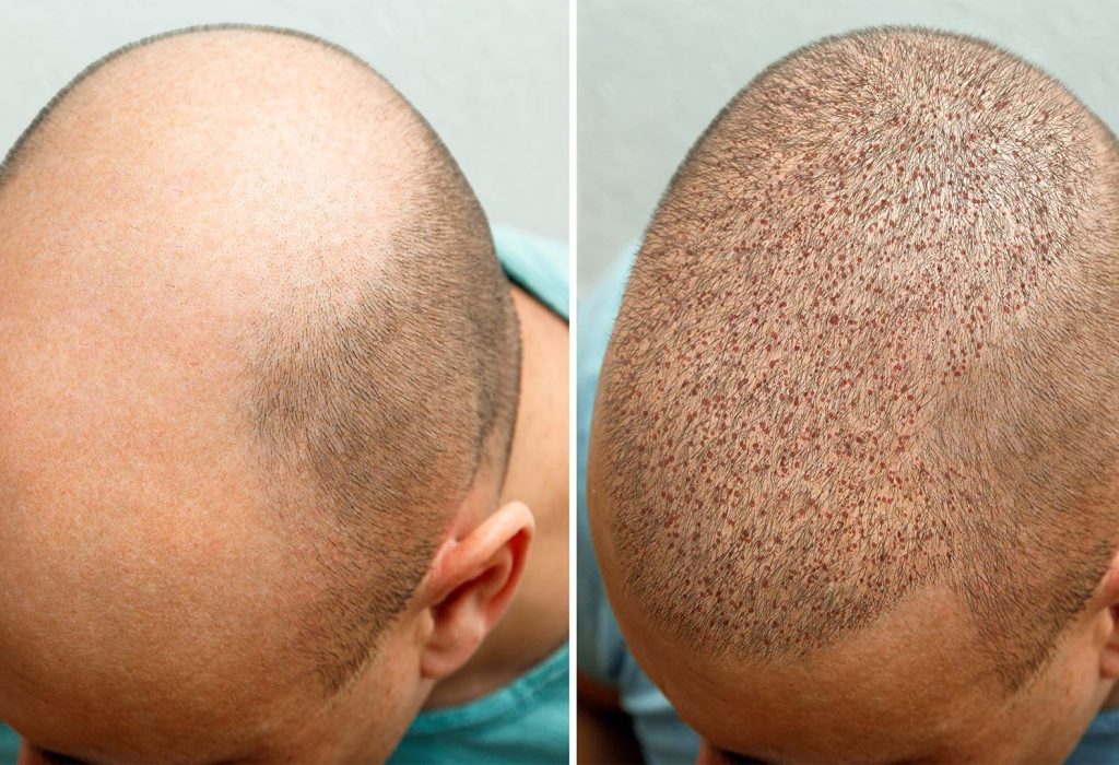 hair-transplant