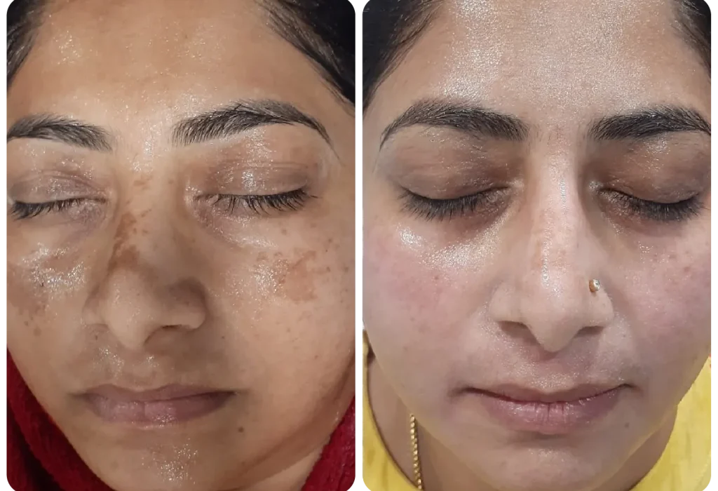 Skin Rejuvenation