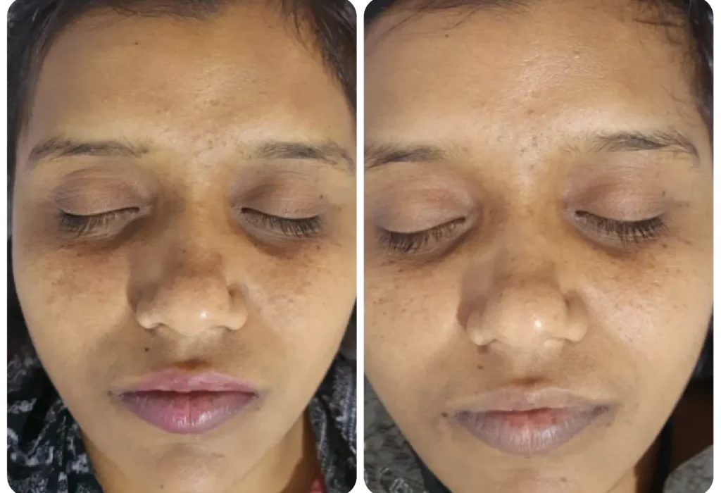 Skin Rejuvenation