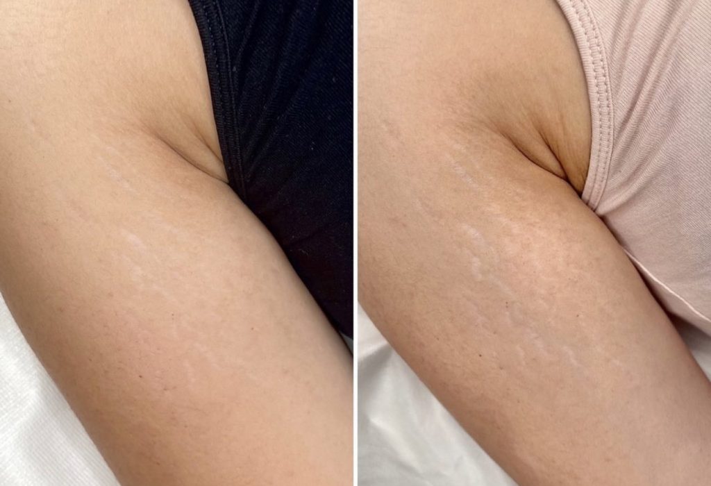 Stretch Mark Removal