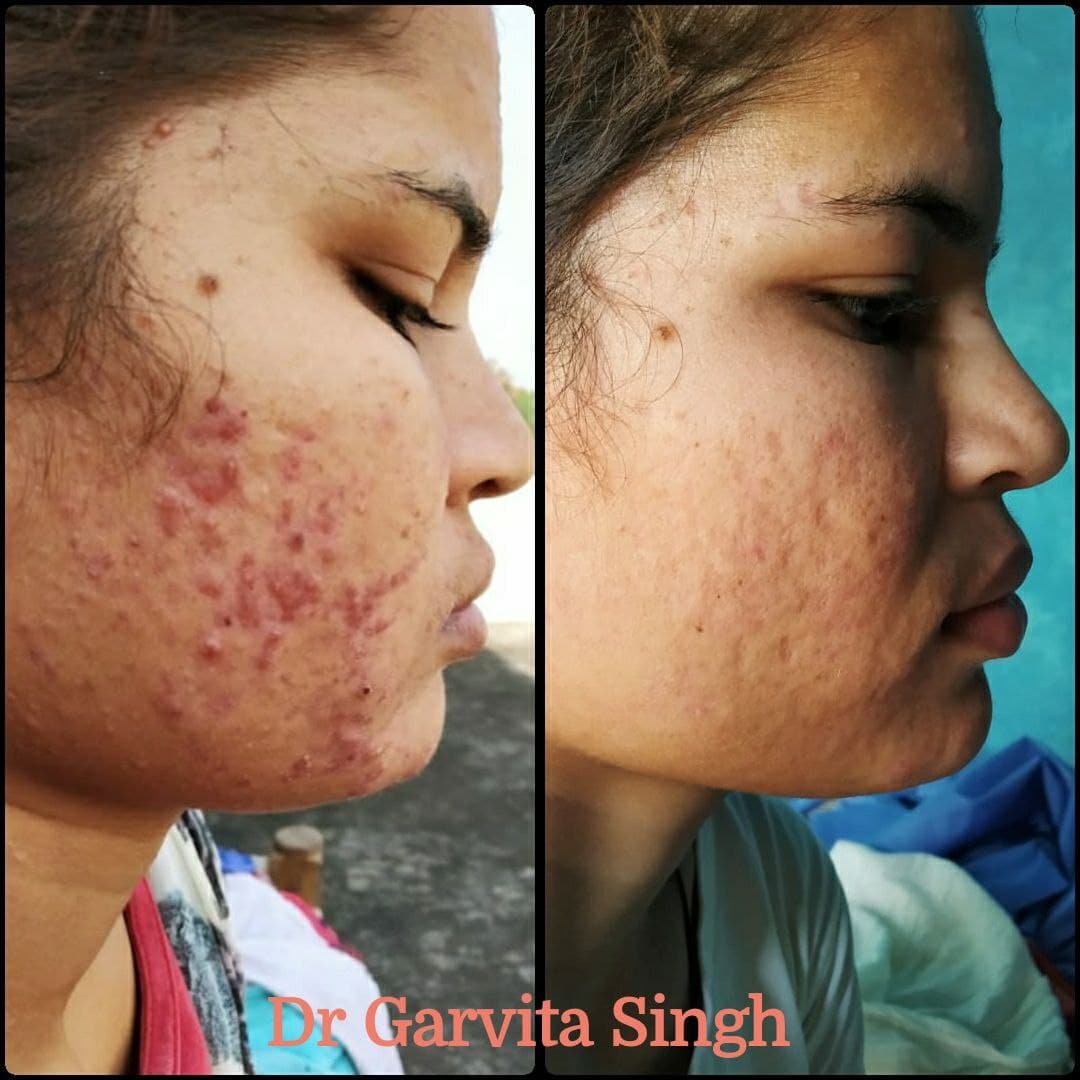 Skin treatment results