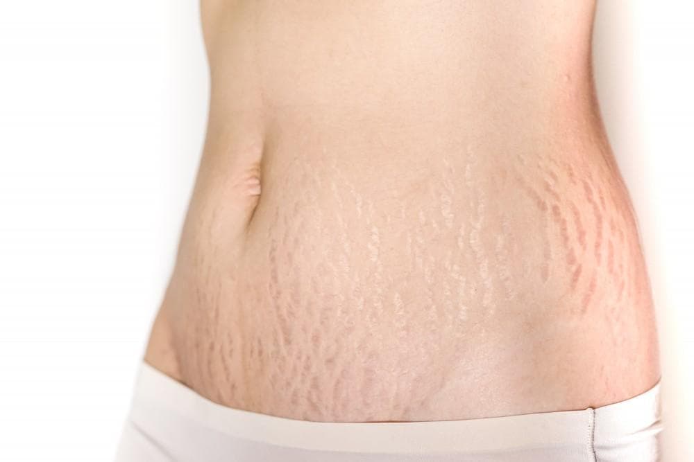 Why Stretch Marks Form and the Best Ways to Treat Them
